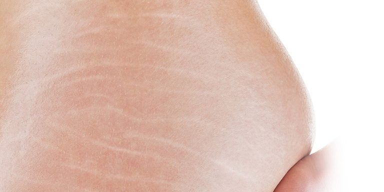 Cách làm mờ vết rạn da ở mông đơn giản cực kì hiệu quả